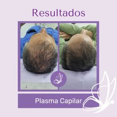 PRP capilar - Dra. Haylen Solarte