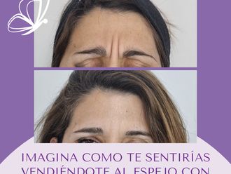 Botox antes y después - 876245