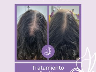 Plasma Rico en Plaquetas antes y después - 876246