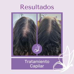 plasma capilar - Dra. Haylen Solarte