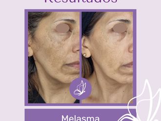Manchas de la piel antes y después - 876247