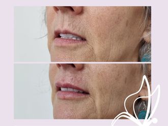 Relleno de labios antes y después - 876248
