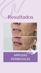 Arrugas peribucales - Dra. Haylen Solarte