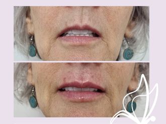 Relleno de labios antes y después - 876249