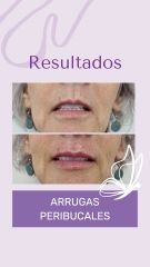 Arrugas peribucales - Dra. Haylen Solarte