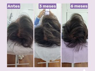Plasma Rico en Plaquetas antes y después - 876250
