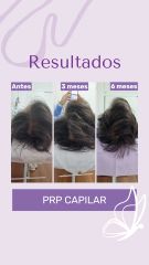Plasma capilar - Dra. Haylen Solarte