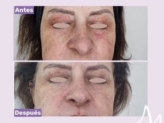 Rosácea antes y después - 876305