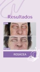 Rosacea - Dra. Haylen Solarte