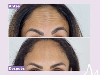Botox antes y después - 876306