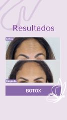 Botox - Dra. Haylen Solarte