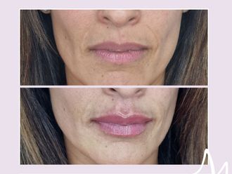 Relleno de labios antes y después - 876307