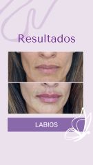 Rellenos de Labios - Dra. Haylen Solarte