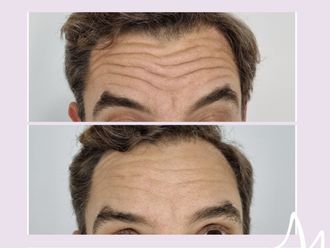 Botox antes y después - 876308