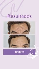 Botox - Dra. Haylen Solarte