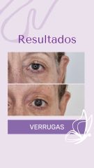 Verruga - Dra. Haylen Solarte