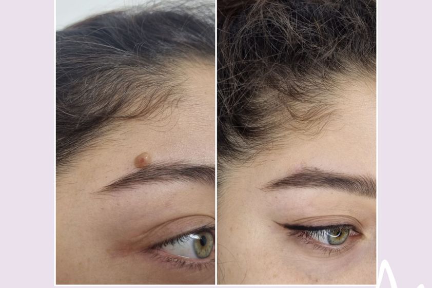 Lunares antes y después - 876310