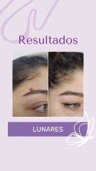 Lunares - Dra. Haylen Solarte