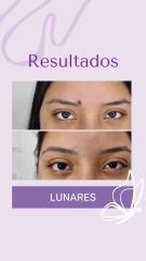 Lunares - Dra. Haylen Solarte