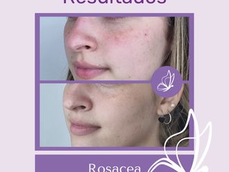 Rosácea antes y después - 876312