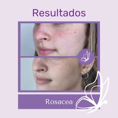 Rosacea - Dra. Haylen Solarte