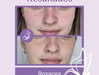 Rosácea antes y después - 876313