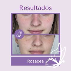 Rosacea - Dra. Haylen Solarte