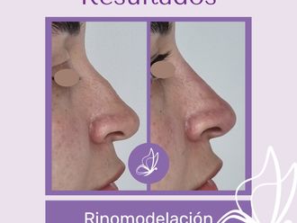 Rinomodelación antes y después - 876314