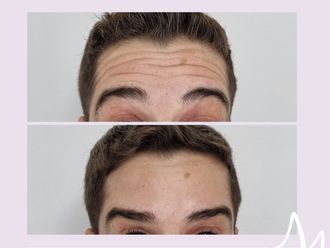 Botox antes y después - 876315