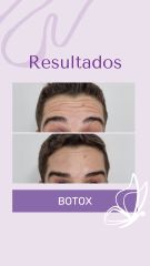 Botox - Dra. Haylen Solarte