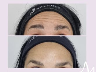 Botox antes y después - 876316