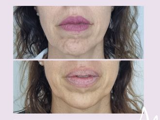 Botox antes y después - 876317