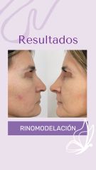 Rinomodelación - Dra. Haylen Solarte