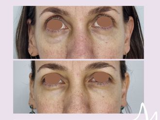 Eliminación ojeras antes y después - 876397