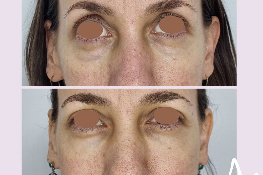 Eliminación ojeras antes y después - 876397