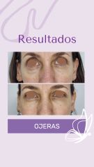 Ojeras - Dra. Haylen Solarte