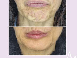 Botox antes y después - 876398