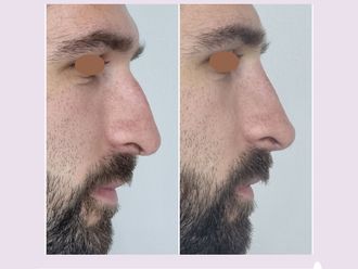 Rinomodelación antes y después - 876399
