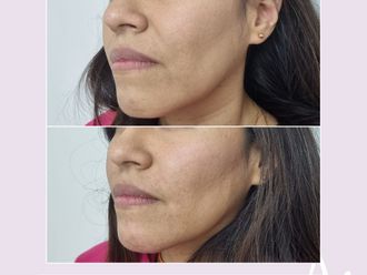 Rejuvenecimiento facial antes y después - 876400