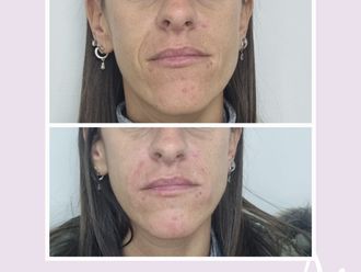 Rejuvenecimiento facial antes y después - 876401