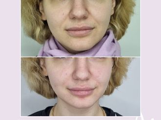 Rejuvenecimiento facial antes y después - 876402
