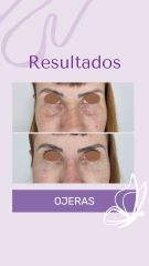 Ojeras - Dra. Haylen Solarte
