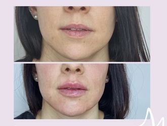 Relleno de labios antes y después - 876404