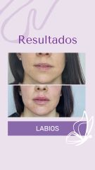 Labios - Dra. Haylen Solarte