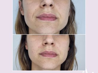 Rejuvenecimiento facial antes y después - 876405