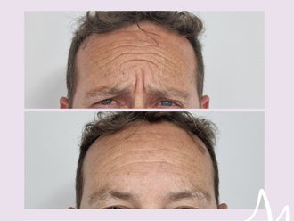 Botox antes y después - 876406