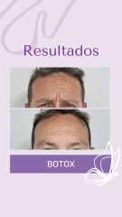 Botox - Dra. Haylen Solarte