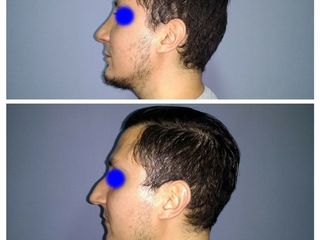 Rinoplastia