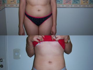 Lipoaspiracion de abdomen