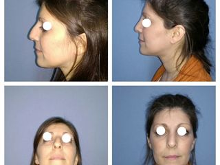 Rinoplastia